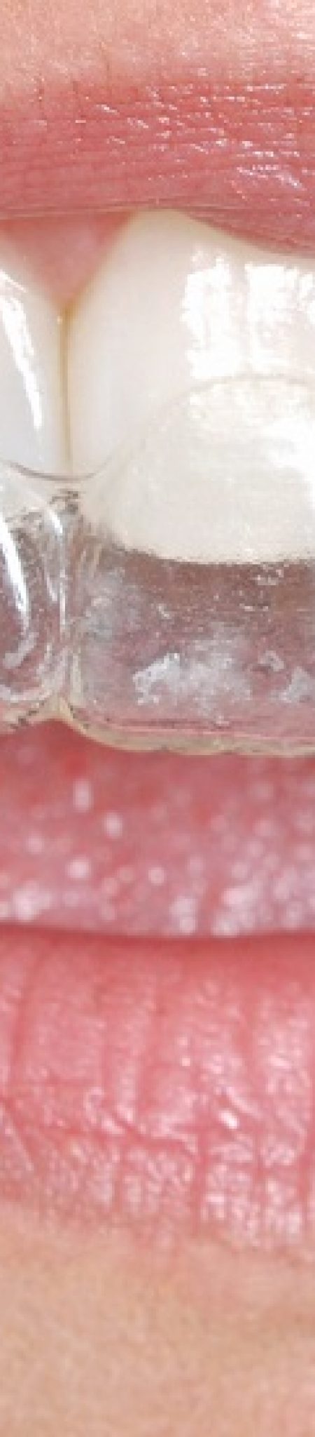 invisalign
