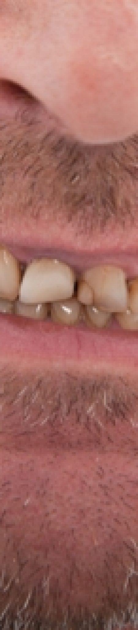 What You Need to Know About Cosmetic Bonding