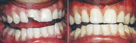 bonded_fillings