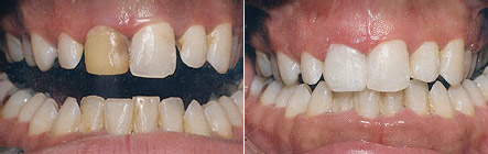 bonded_fillings