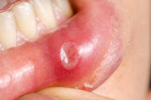 Lessen Canker Sore Irritation During Holiday Eating