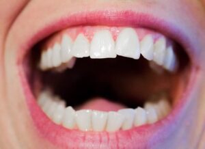 Healthy Teeth and Gums