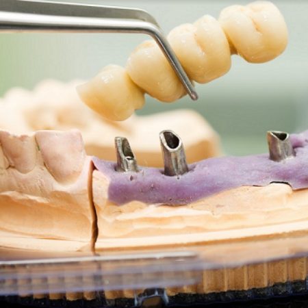 How Crowns Help You Eat and Speak
