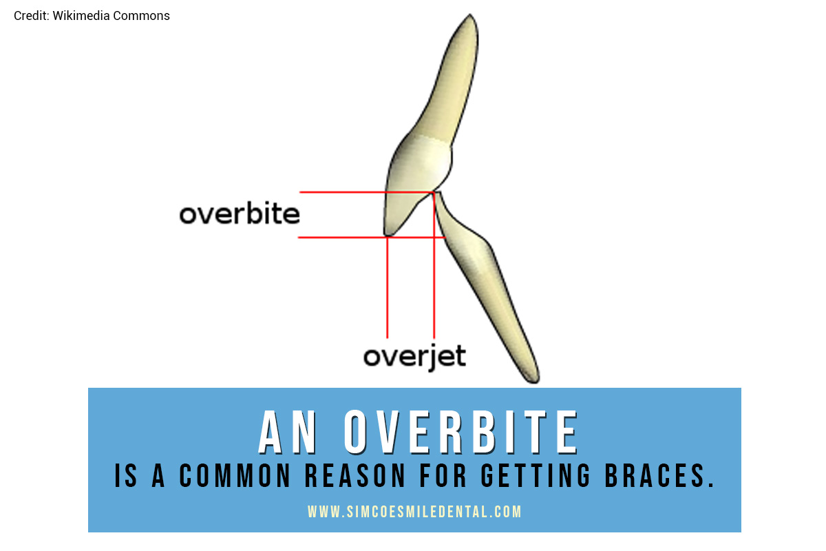 How Do I Know If I Need Braces