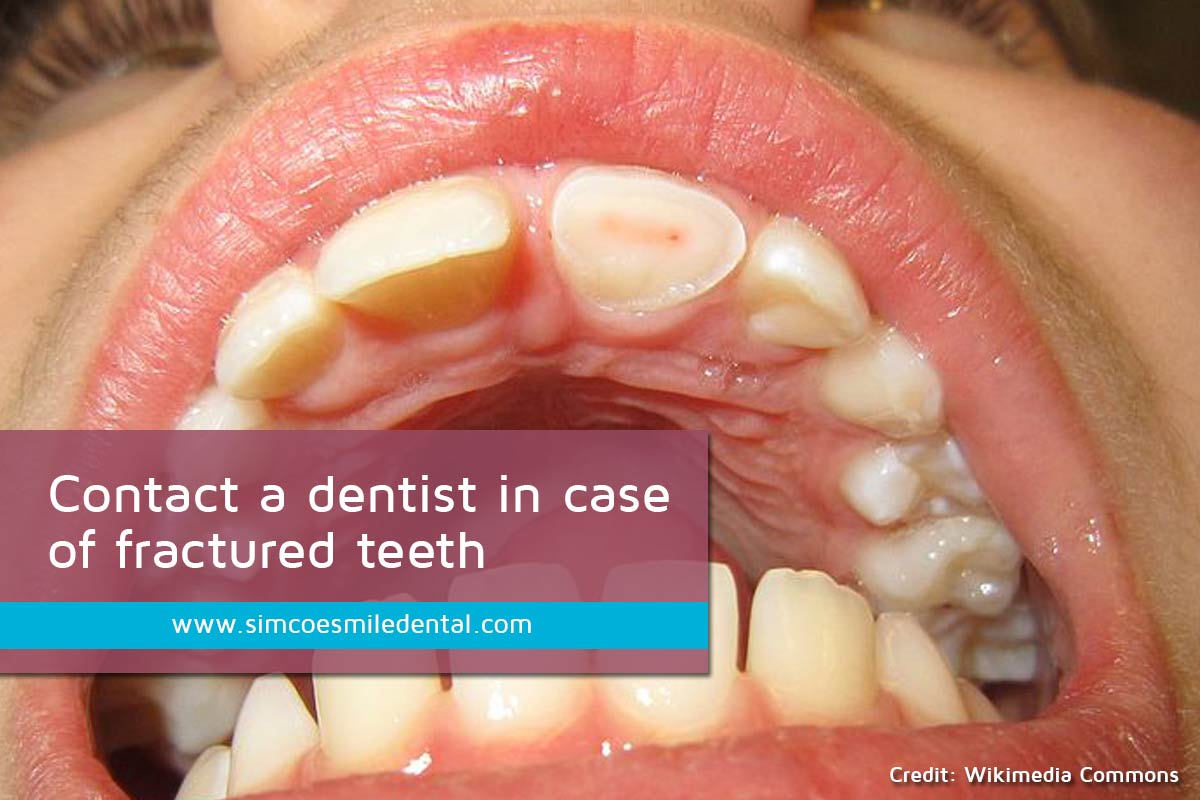Signs You May Need Dental Implants