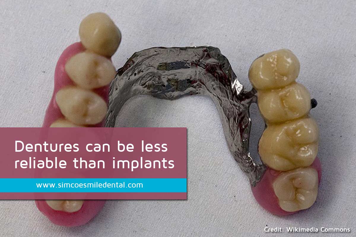 Signs You May Need Dental Implants