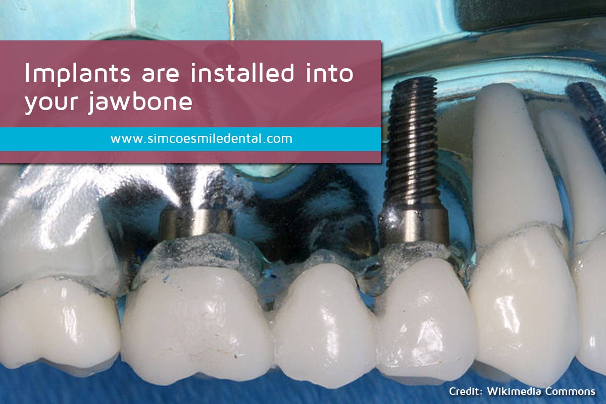 Signs You May Need Dental Implants