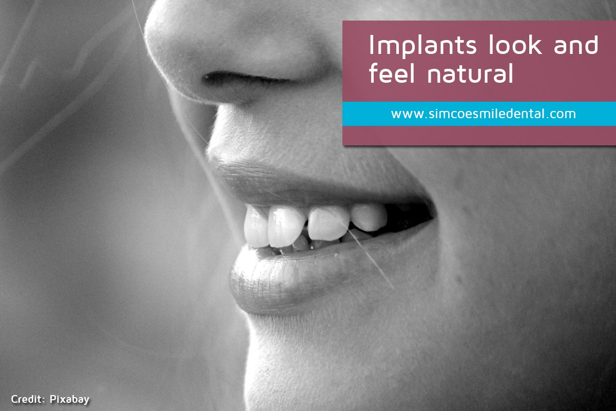 Natural looking dental implants