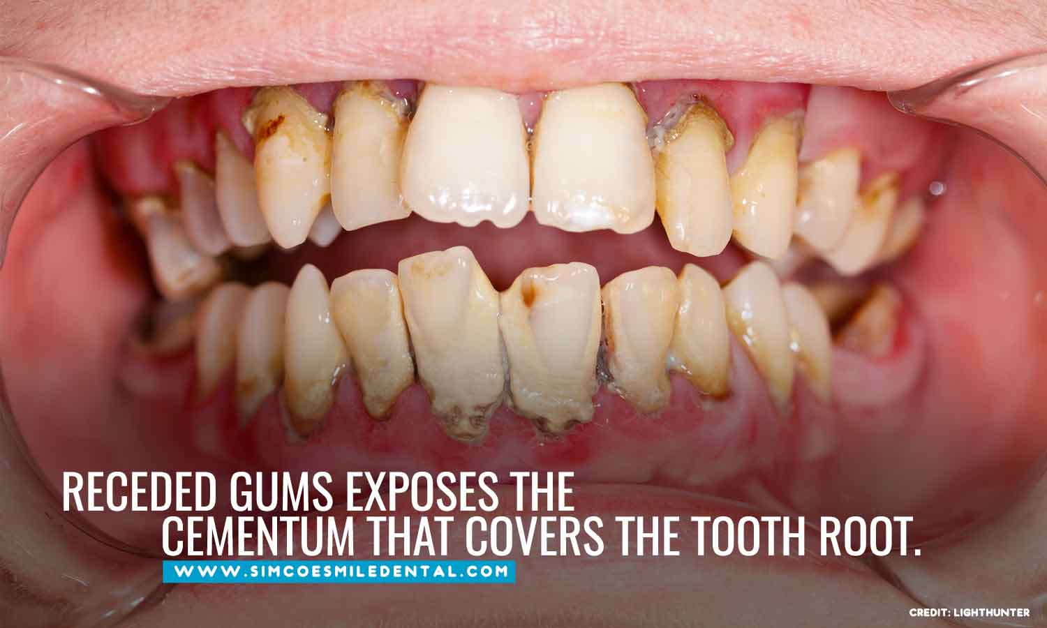 Overbrushing And Its Effects On Your Teeth