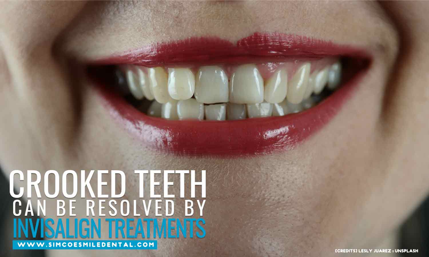 What to Expect From Invisalign Treatment