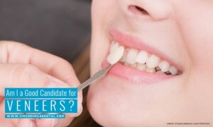 Am I a Good Candidate for Veneers?