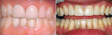 Before and after photos: new porcelain front crowns
