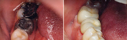 Before and after photos: black back fillings replaced with crowns