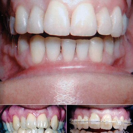 Adult braces: the finished smile, with before and after close-ups underneath