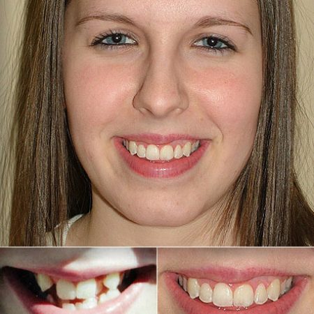 Braces for kids: the finished smile, with before and after close-ups underneath