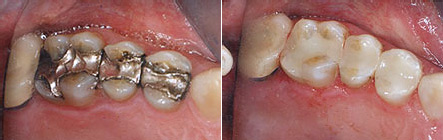 Before and after photos: metal fillings replaced with tooth-coloured fillings, second patient