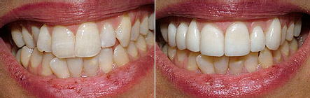 Before and after photos: 7 veneers on overlapped teeth