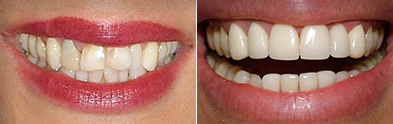 Before and after photos: 8 upper and 4 lower veneers