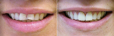 Before and after photos: 2 veneers on chipped front teeth