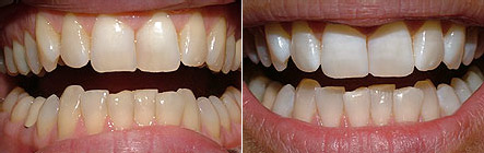 Before and after photos: Zoom whitening, before on the left and after on the right