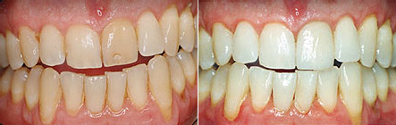 Before and after photos: 1 veneer plus whitening, before on the left and after on the right